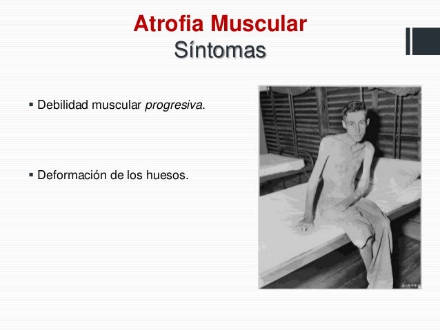 atrofia muscular progresiva